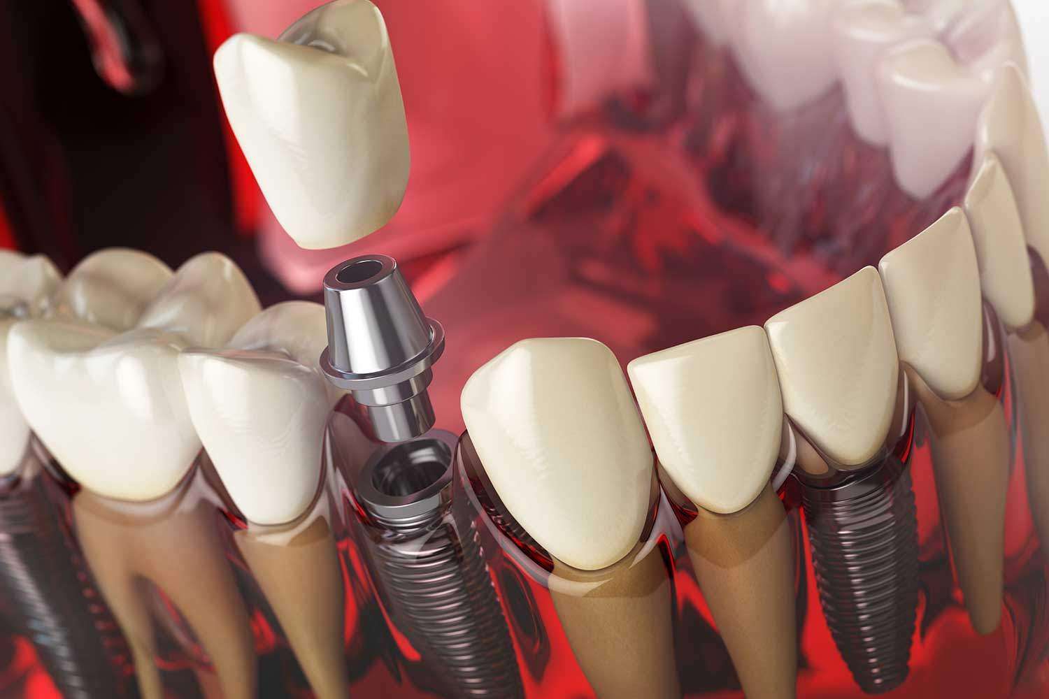 carga imediata dentes fixos