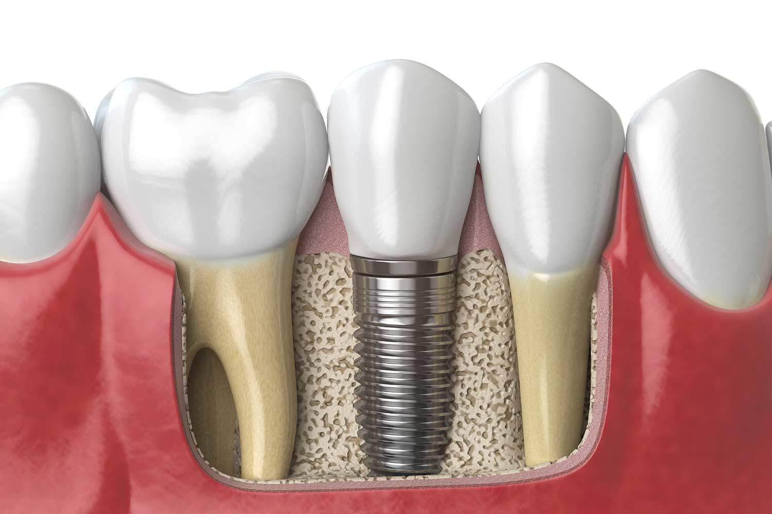 implantes dentarios