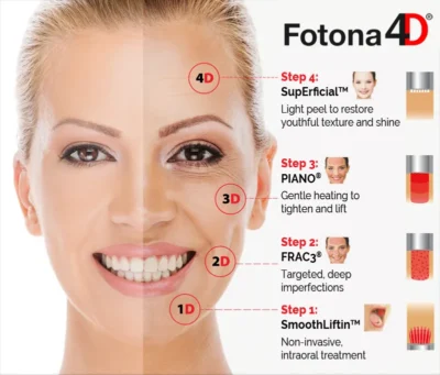 how does laser fotona D works algarve faro almancil