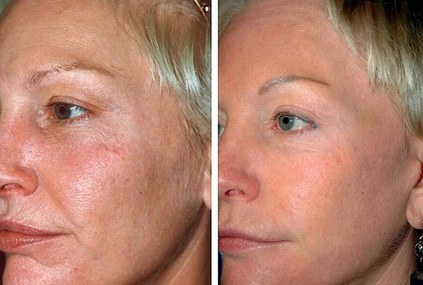 Antes e Depois Fotona Laser em Portugal
