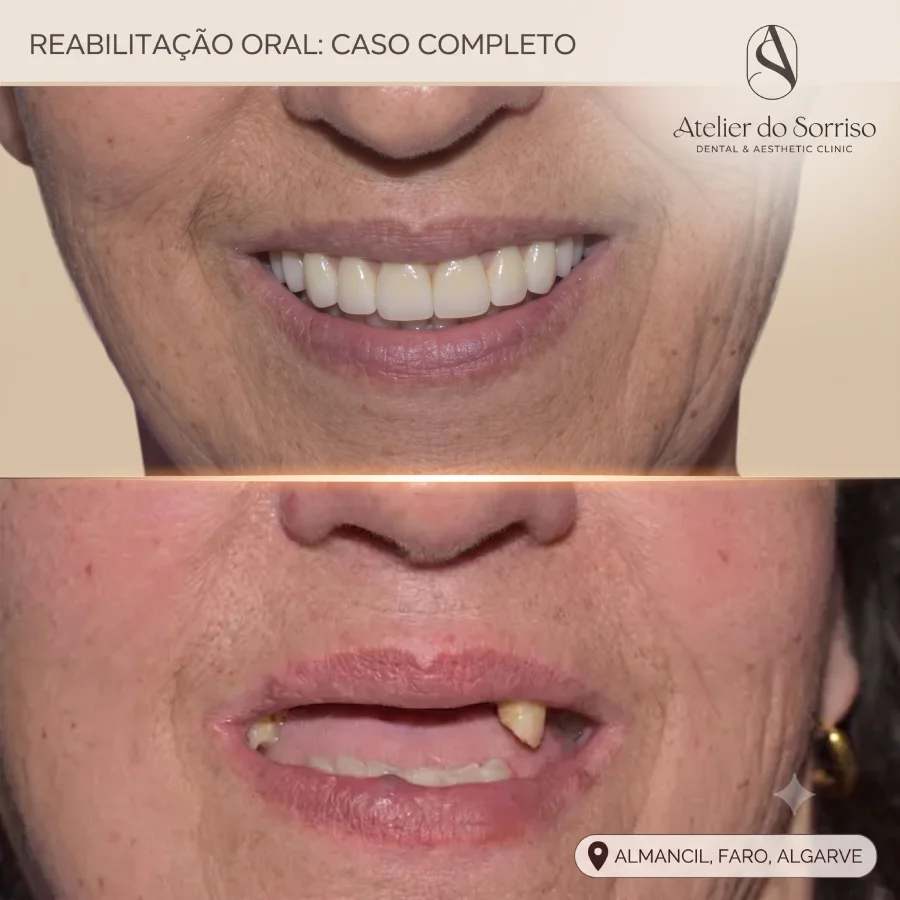 caso antes depois reabilitacao dentes fixos horas all on four algarve b