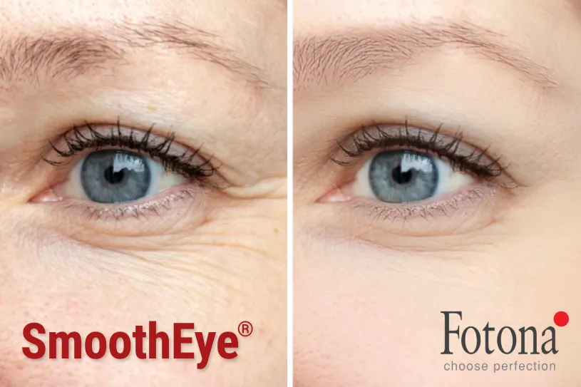 Smooth Eye Fotona Antes Depois Algarve
