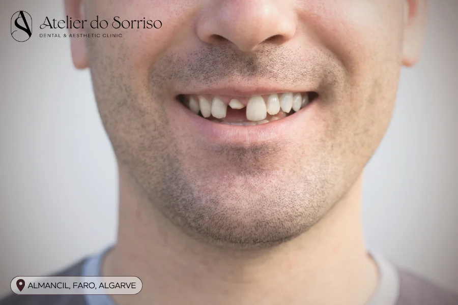 parti dente fratura algarve faro almancil parti dente fratura algarve faro almancil