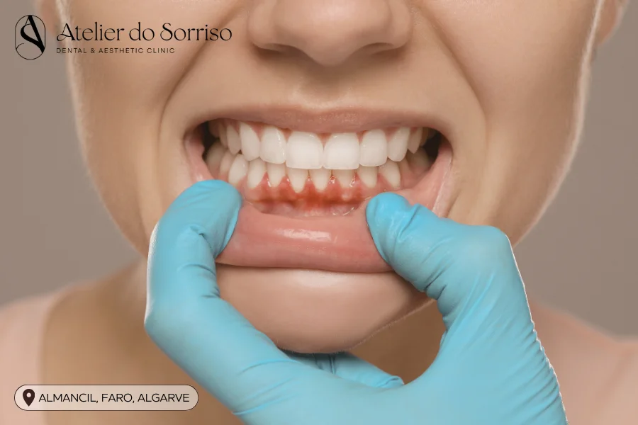 tratar gengivite periodontite algarve faro almancil
