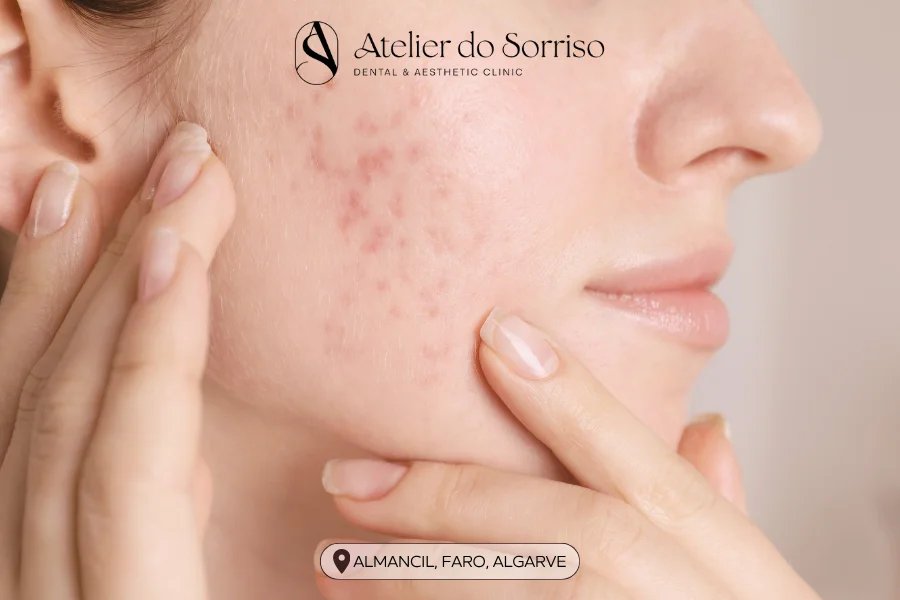 tratamentos cicatrizes acne algarve faro almancil tratamentos cicatrizes acne algarve faro almancil