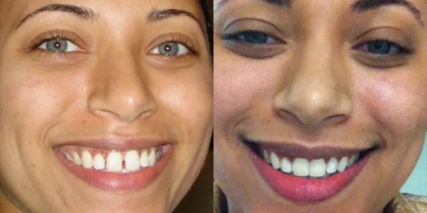 Invisalign Antes Depois Caso