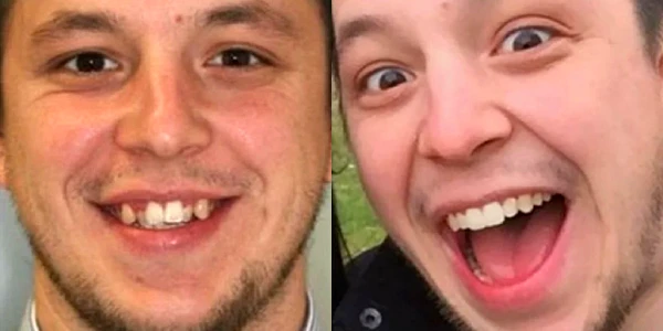 Invisalign Antes Depois Caso