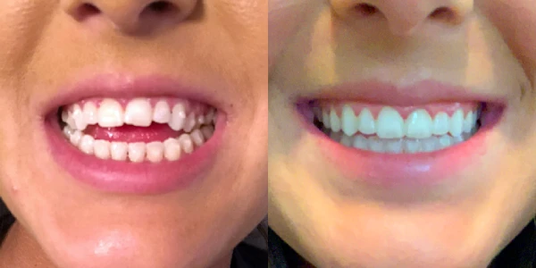 Invisalign Antes Depois Caso