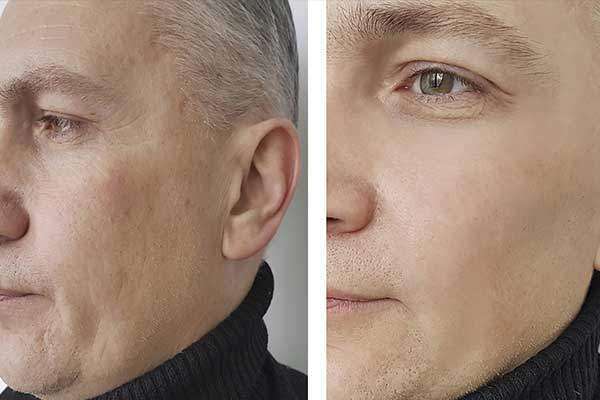 botox homens cara testa olhos