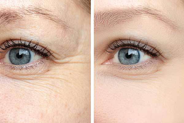 botox mulheres olhos