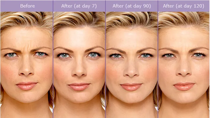 caso aplicacao botox algarve