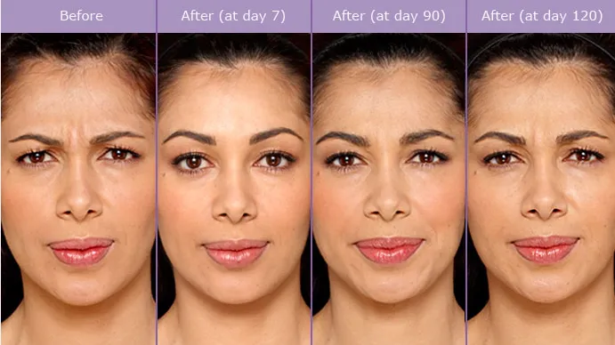 caso aplicacao botox almancil