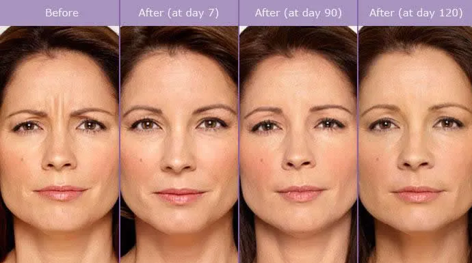 caso aplicacao botox faro