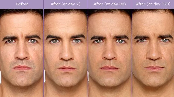 caso aplicacao botox homem quarteira