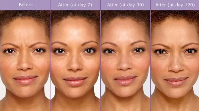 caso aplicacao botox vilamoura