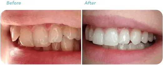 invisalign antes depois dentes tortos pra dentro