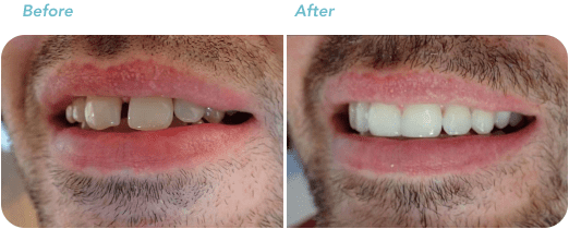 invisalign before after treatment