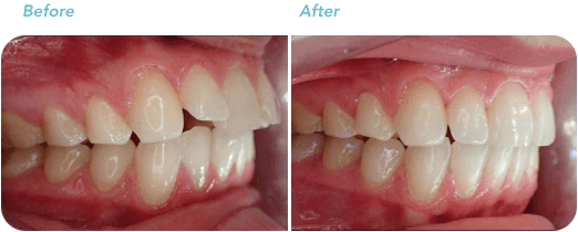 invisalign before after treatment