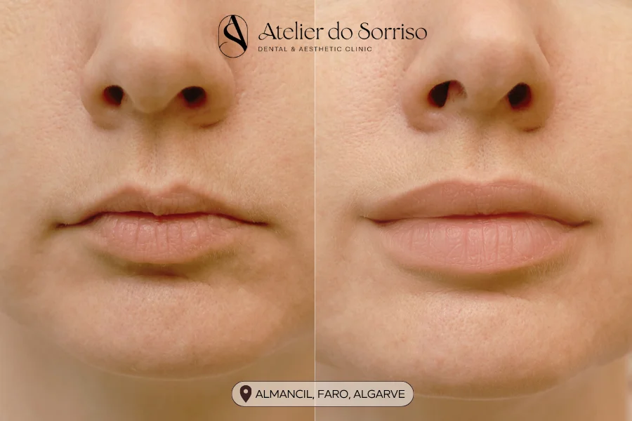 preenchimento labial algarve faro almancil