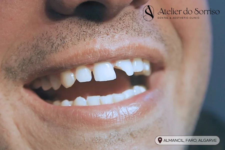 pode colar dente quebrado algarve faro almancil