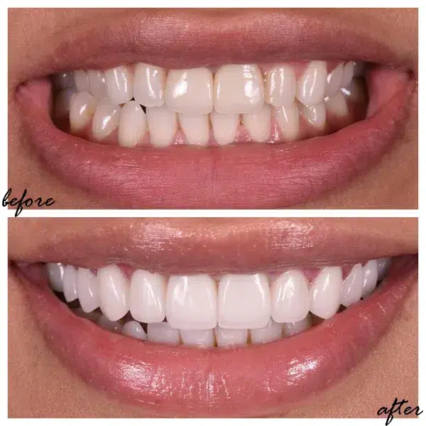 facetas dentarias antes depois faro almancil .webp